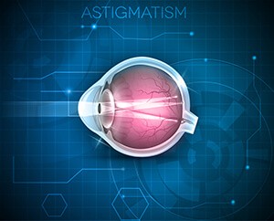 Treating Astigmatism