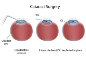 Cataract Surgery Dallas