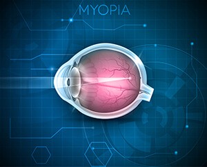 Nearsightedness/Myopia