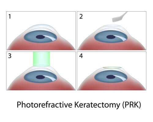Photo Refractive Keratectomy