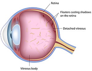 Vitreous Floaters