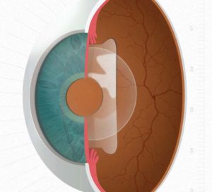 Implantable Collamer Lens Dallas Implantable Collamer Lens