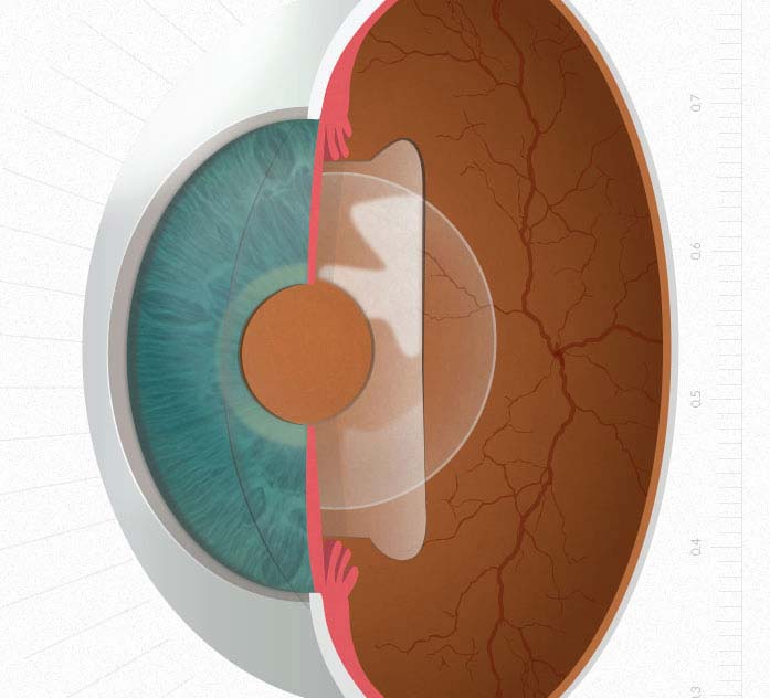 Dallas Implantable Collamer Lens