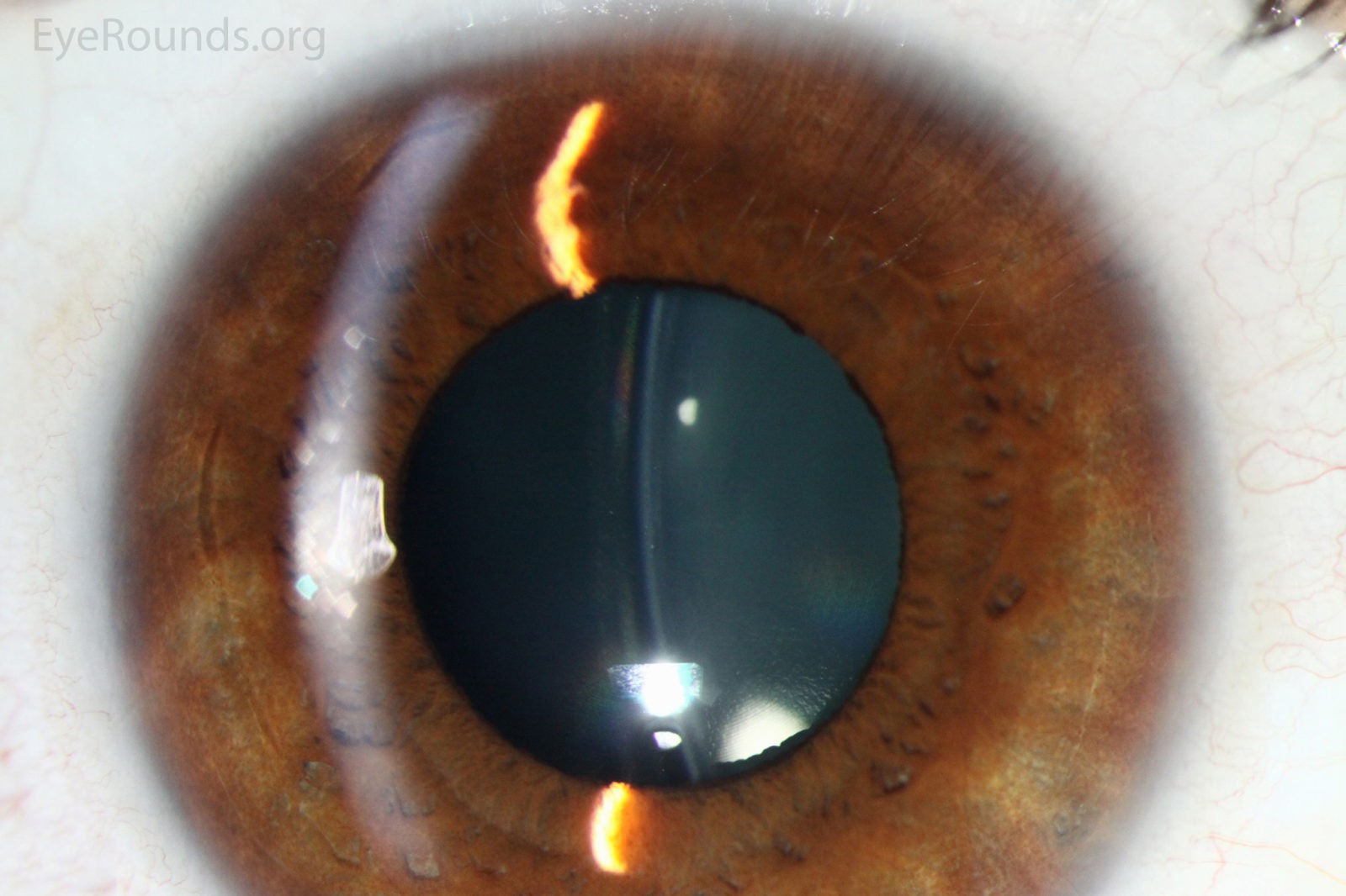 ICL for High Myopia